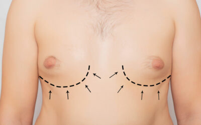 Gynecomastia Surgery: Understanding the Procedure, Benefits, and Recovery